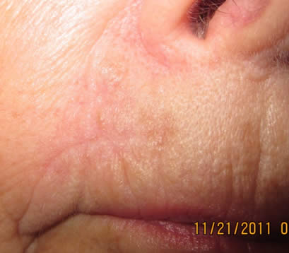 Skin cancer on lip post MOHS surgery 2 months